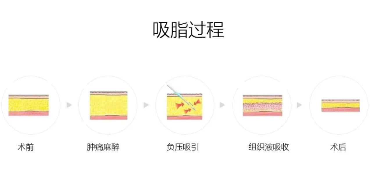 最新吸脂技术，重塑身材的革新之道