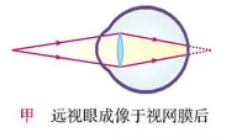 全球最新近视治疗技术，重塑清晰视界的新纪元