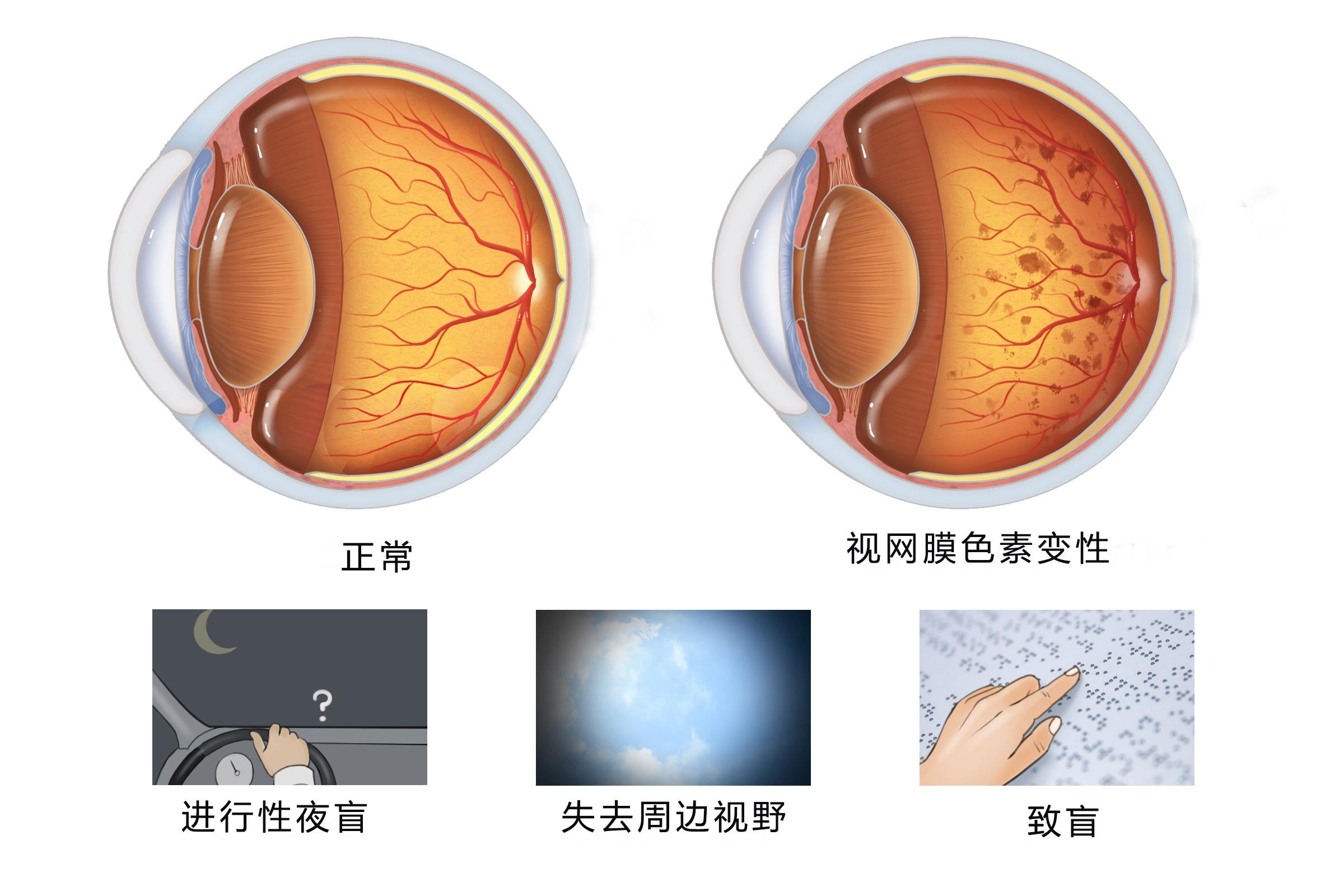 视网膜色素变性最新研究进展与前沿治疗方法探索