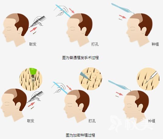 美国最新植发技术，重塑自信，开启新生活